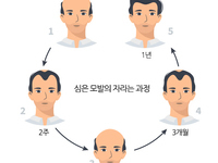 모발이식 후 바로 원하는 결과 볼 수