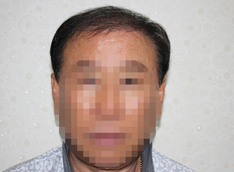 시술 후 사진