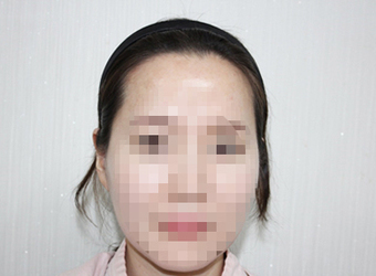 시술 전 사진