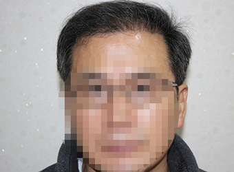 시술 후 사진
