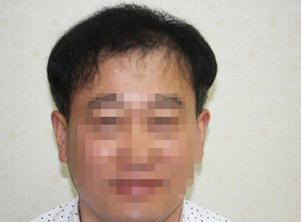 시술 후 사진